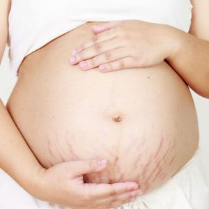 striae-zwangerschap