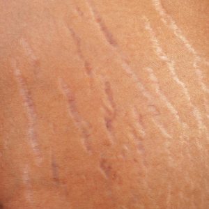 striae